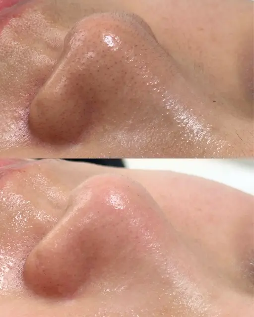 【タマゴ肌コース】12600→8480