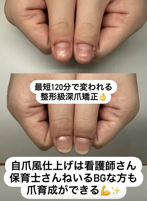 【新規様限定】ハンド深爪矯正/周りにバレずに深爪矯正〜まるで自爪が伸びたような自然な仕上がりで長さ出し