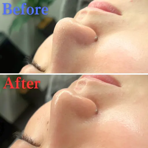 【人気No.1🔥角栓汚れゴッソリ】毛穴洗浄（顔全体​〜​首） ×イオン導入乾燥対策◎ニキビやいちご鼻でお悩みの方にも♪