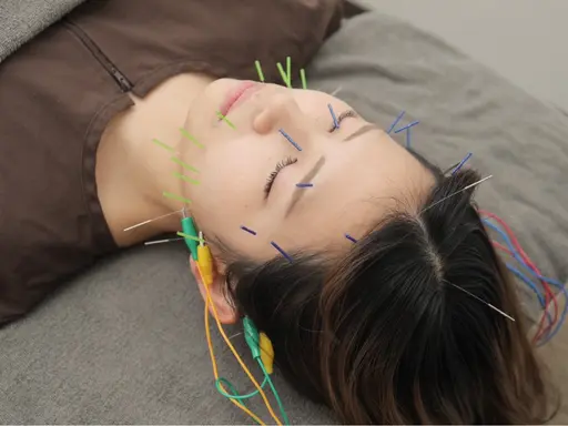 口コミ&写真撮影📷にご協力いただける方🙇‍♀️ 美容鍼　（45分）　💄メイクオフ不要