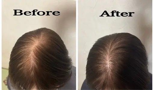 増毛500本＋ヒト幹細胞ヘッドスパ＋プラセンタ育毛剤付き✨