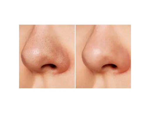 【☆毛穴ケアNo.1☆】毛穴洗浄&美容液（ビタミンC、コラーゲン、ヒアルロン酸）導入✨鼻とホホの毛穴を引き締めつや肌へ✨