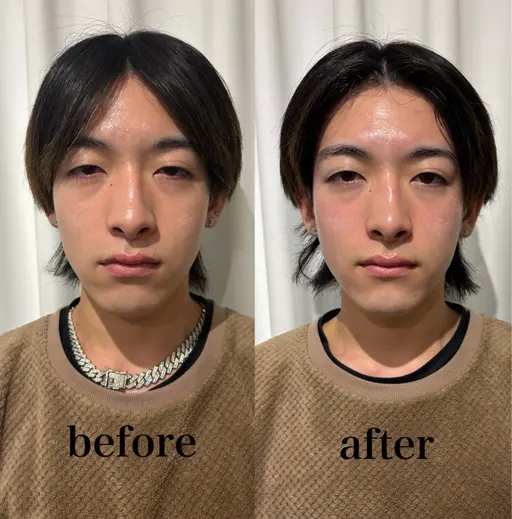 メンズ👨美容鍼【水曜日以外】男性4回モニター様特別価格1回7900円1週間に一度いらっしゃれる方限定🉐EMS🎁付き