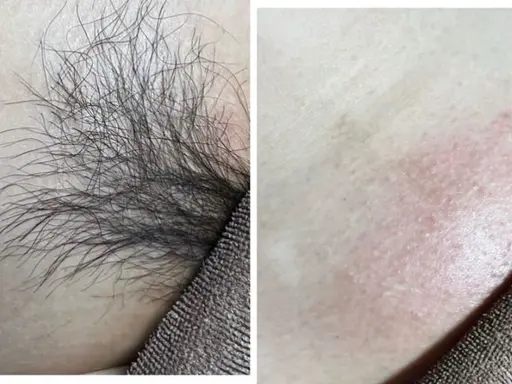 VIOワックス◽️2回目以降のお客様¥4000