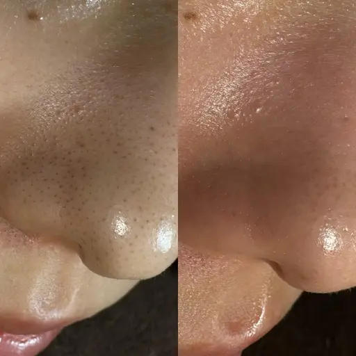 minimo限定★最新★毛穴洗浄フェイシャルエステ肌質改善❤︎オルチャン肌毛穴・黒ずみなし