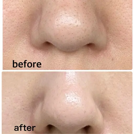 2月まで限定！黒ずみ毛穴洗浄×全顔導入付き【角栓詰まり黒ずみ◎ざらつき】角栓ポップアップ洗浄！角栓浮き上がり◎つるん肌♪