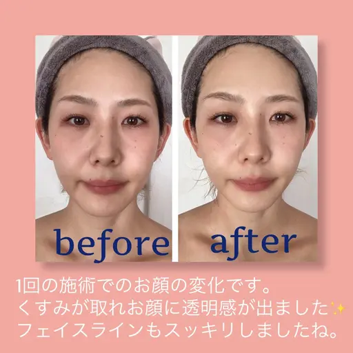 EMSでぐいっと引き上げ👶💫美顔器ありベーシックフェイシャルトリートメント💆‍♀️✨✨
