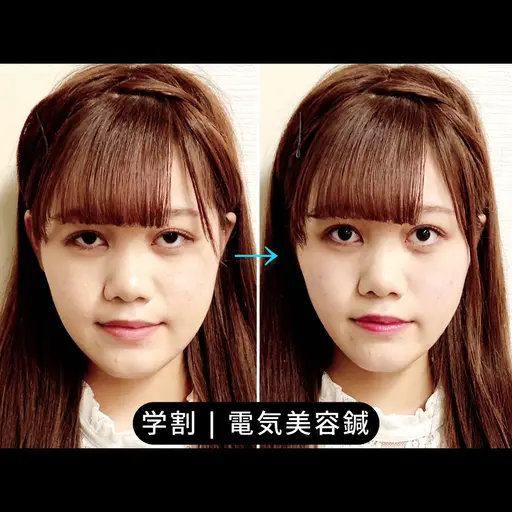 【卒業・新生活に◎】ミニモ学割U24 小顔美容鍼×EMS 30分