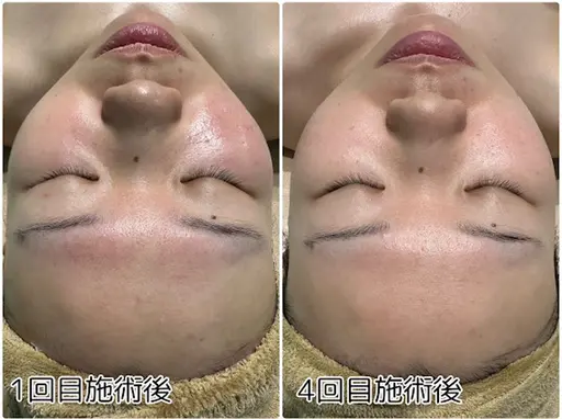 剥けないハーブピーリング🌿ダウンタイム無し！施術後直ぐに化粧OK🙆‍♀️