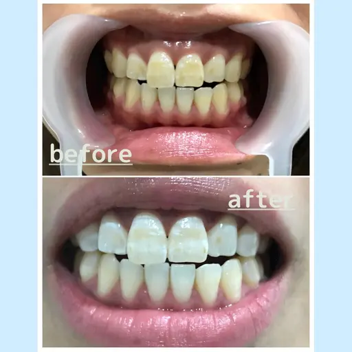 【学生限定】セルフホワイトニング初回お試し通常¥3500→¥2500💐