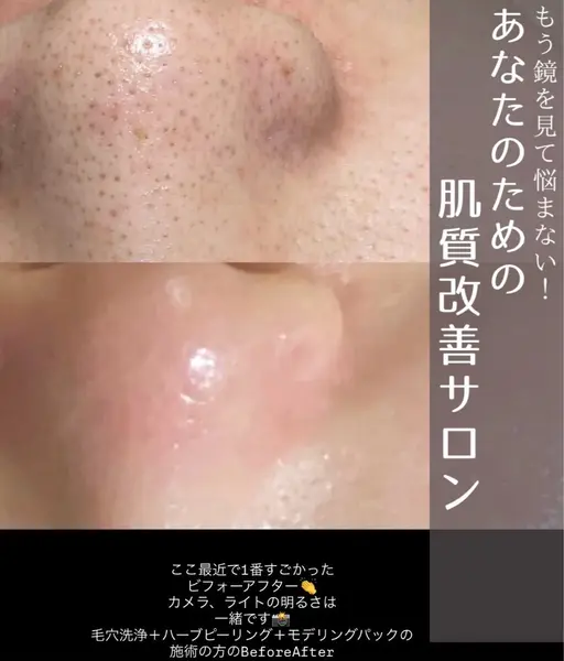 【3月限定🌸】全顔毛穴洗浄×ハーブピーリング×腸揉みマッサージ70分［自分史上最高のツヤ肌へ］