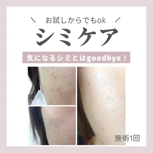 シミケアトライアル💆♀️♡まずはお試しから💓