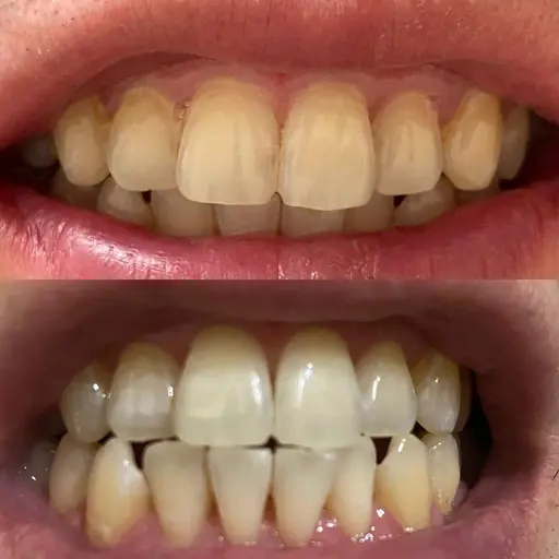 ホワイトニング15分✖️2回