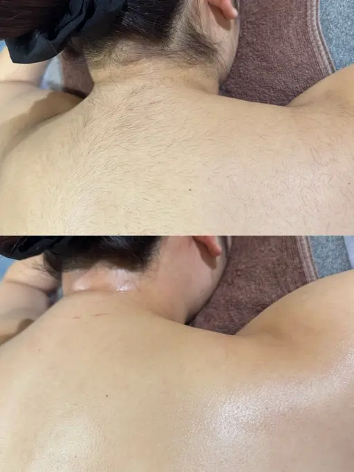 背中ワックス脱毛＋うなじダブル脱毛🍒産毛から太い毛までしっかり脱毛🪞🫧