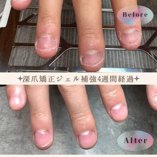 自爪.深爪育成ジェル