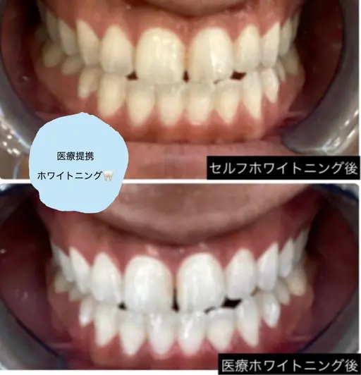 【医療ジェルだから出来る！驚きの白さを】医療提携×セルフホワイトニング¥20000→¥9000