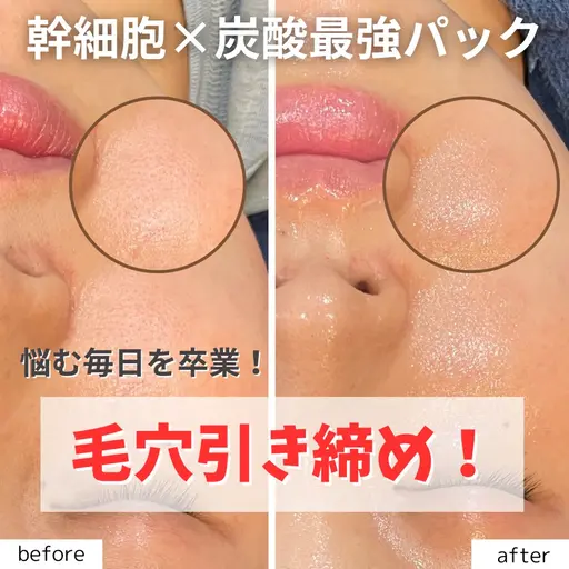 12/5限定!!肌悩み集中ケア!【毛穴の開き・くすみ・むくみ改善!】ピーリング+整形級炭酸パック(ニキビ用に変更OK)