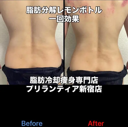 【痩身冷却2箇所&分解レモン✨/ボディ】すっきりお腹