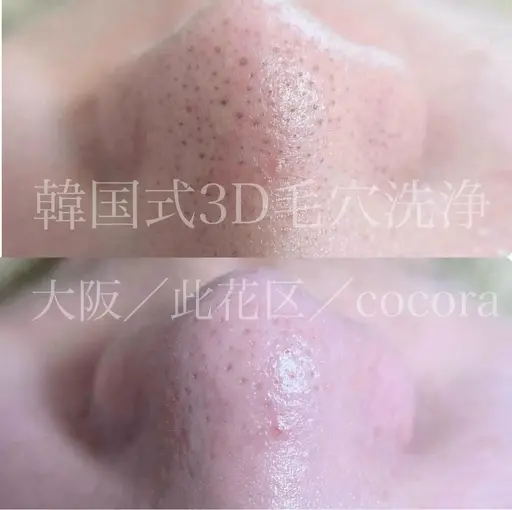 韓国式3D毛穴洗浄 口コミ、LINE登録してくれる方