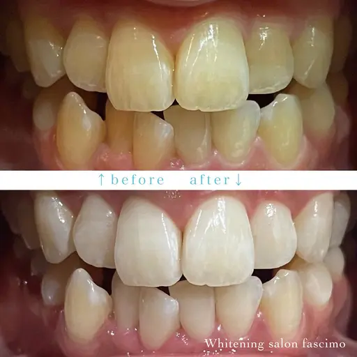 ㊗️１周年記念キャンペーン🎉8分×2回照射💡セルフホワイトニング6,600円→1,580円🫧２倍効果パープルライト