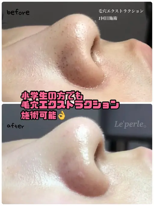 【ごっそり毛穴角栓】毛穴エクストラクション(鼻のみ)☆モニター様募集☆
