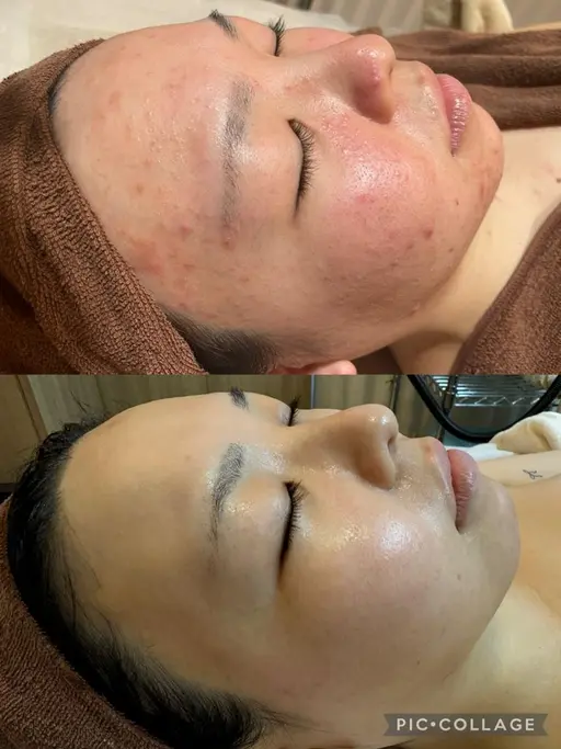 🎄クリスマス前限定🎄19歳～21歳限定🌟べたつき悩み。ごっそり毛穴洗浄＆ポレーション導入！お肌の水分量UP⤴︎