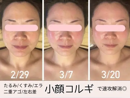 【女性限定】即効性抜群❣️小顔コルギ💆🏻♀️モデル様募集💛45分✨むくみスッキリ✨肩や首こりも同時に解消☺️