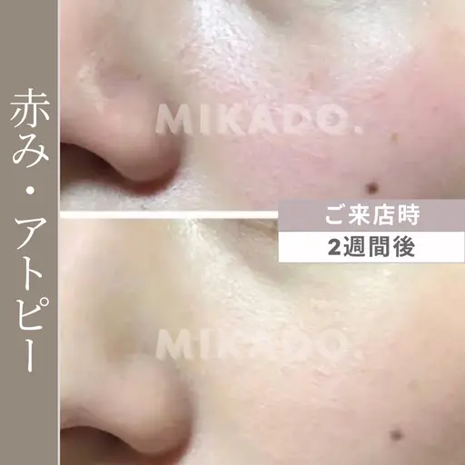 【赤み、アトピーに】本気で肌質改善！天然ハーブピーリング　グリーンピールソフト1Days ¥13240