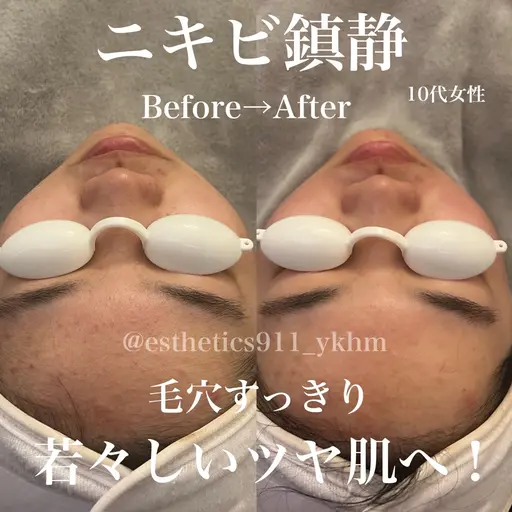【お昼限定】肌荒れニキビ毛穴ケア！水素高周波のWアプローチ！フェイシャルエステコース初回