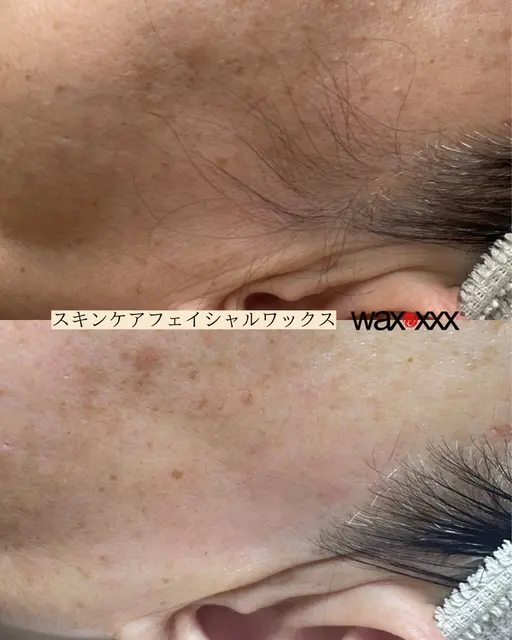 スキンケアフェイシャルWAX脱毛