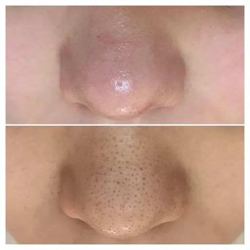 毛穴洗浄🫧高保湿リフトマスク付き¥12,100→6,600