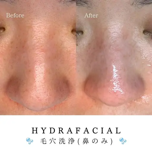 🫧ハイドラフェイシャル🫧黒ずみ改善毛穴洗浄(鼻のみ)レディ¥3,300(メンズ＋1000円)
