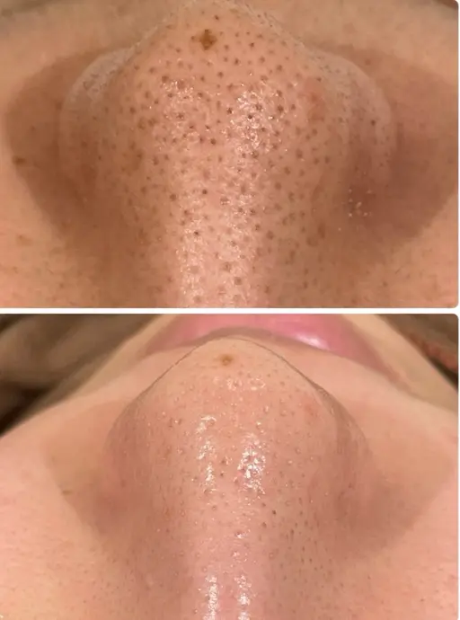 毛穴洗浄✨こんな黒ずみにお悩みの方！モニター様