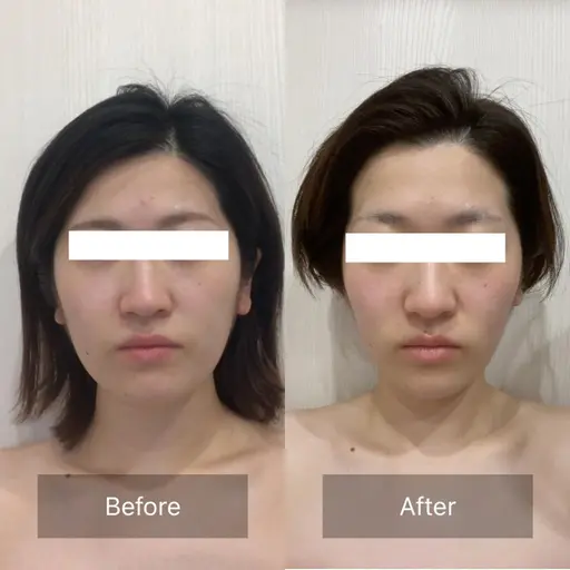 【即小顔×たるみゼロへ♪】脳洗浄®︎小顔ヘッドスパ　デコルテ付き100分　前日・当日予約限定価格‼︎