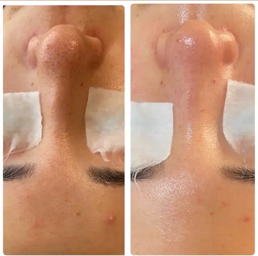 【10月👻🎃15名様限定】毛穴洗浄 モニター