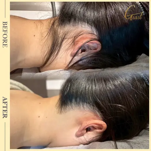 12/14(日)空き◎髪をまとめた瞬間気になる【別人級の仕上がりに感動】うなじ脱毛✨️