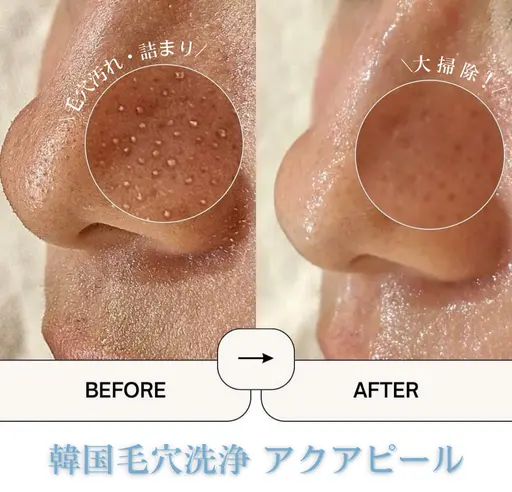 【1日3名限定】モニター価格🉐韓国式毛穴洗浄 アクアピール🫧✨黒ずみ/いちご鼻/角栓汚れ　¥5,500→3,400