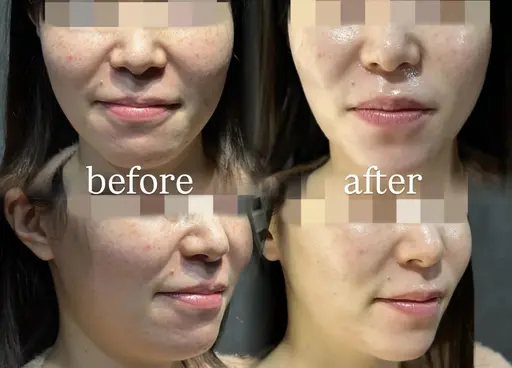 【1日2名限定】肌管理モニター🫧毛穴・ニキビ・赤み・ザラつき改善／フェイシャル歴6年以上のベテランスタッフ施術✨