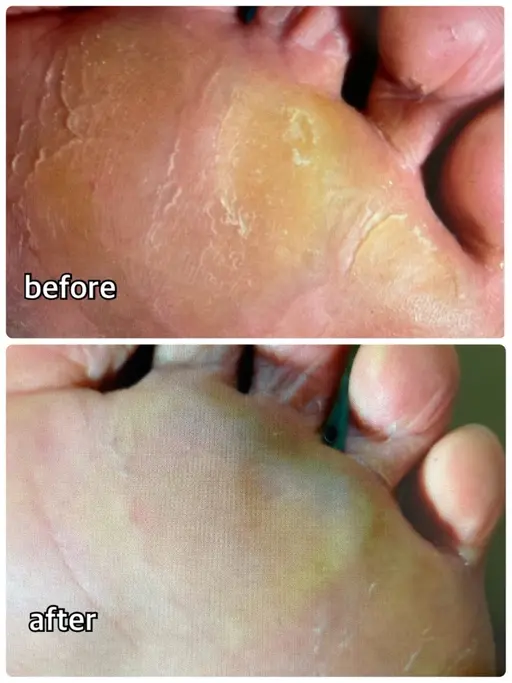 フットケア(足裏角質除去)