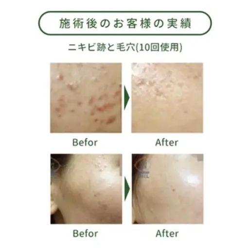【人気NO1★専門家推奨】毛穴・ニキビ・美白・ハイドラ+ハーブピーリング+ヒアルロン酸+LED60¥26800→6500
