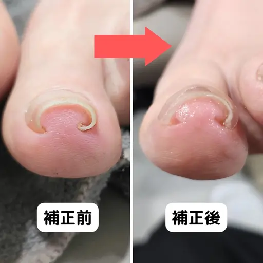 巻き爪の補正
