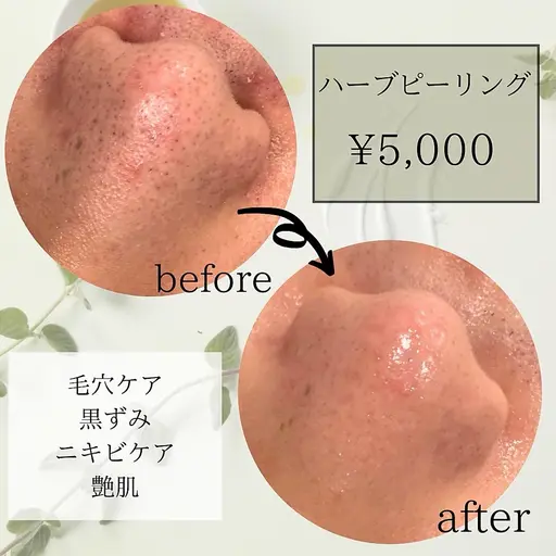 【剥離なし】毛穴悩み改善&ニキビケアに◎ ハーブピーリング ¥5000