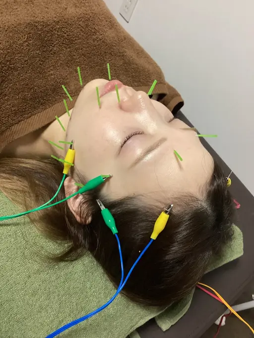 🌱人気No.2《美容鍼》電気パルス・首調整・ヘッドマッサージ付き