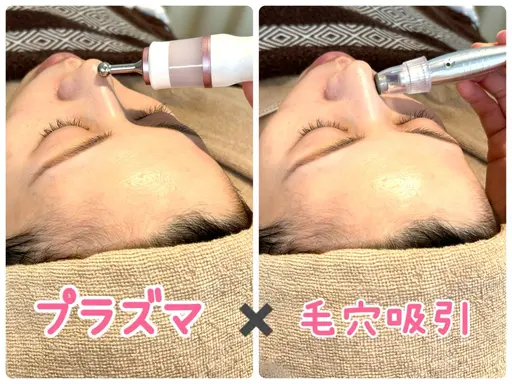 【黒ずみ毛穴に特化✨】頑固な毛穴汚れ一つ一つに反応するプラズマ✨皮脂汚れ分解後ごっそり毛穴吸引😳✨開き・たるみ毛穴にも