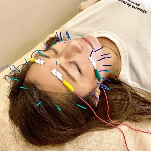 ミニモ限定✨新規VIP✨5500円オフ🎵9900円(施術2回分の美容鍼×小顔電気⚡(short ver)