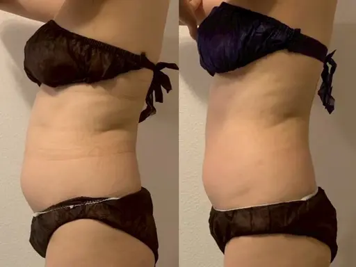 脂肪撃退セラム＋キャビテーション×EMS×ラジオ波×吸引で圧倒的サイズダウン✨ダウンタイムなしリバウンドなし🙆‍♀️