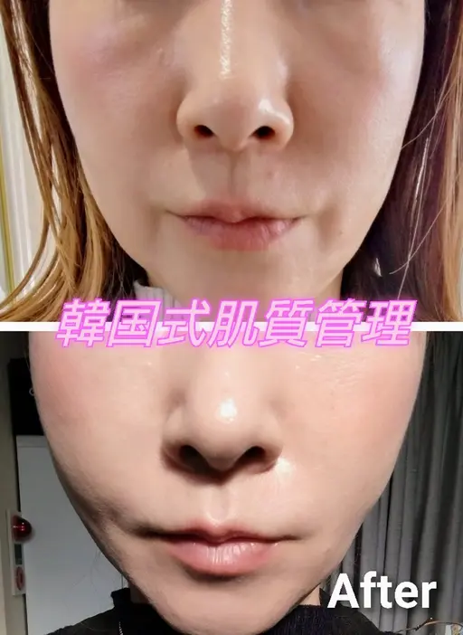 【ミニモ限定】最新機器使用❗韓国小顔✨老け顔・たるみ・むくみ・シワ❗最強❗深層筋肉運動【細胞成長因子✨ヒト幹細胞導入】