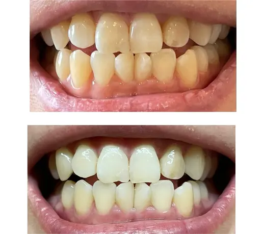 歯のセルフホワイトニング15分照射