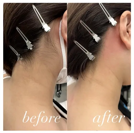 【うなじワックス脱毛】🤍ྀི角質も一緒にケアしてツルスベ肌に✨トーンアップ効果🫧