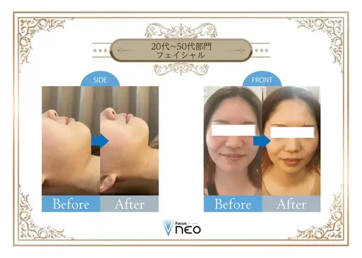 【2回目以降】【小顔✖️美肌マシーン💖4000shot】＋パック付き